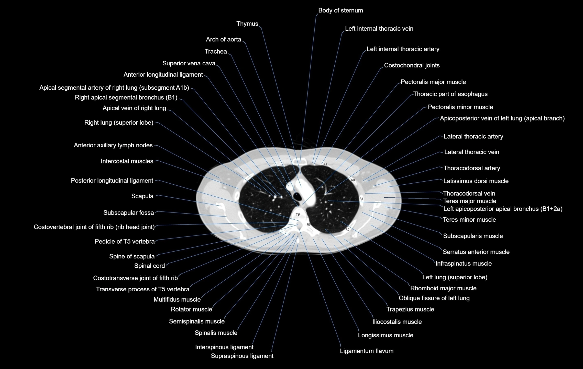 CT chest (thorax) labelled axial cross sectional anatomy radiology image-00033.webp